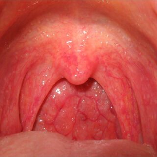 Pharyngitis